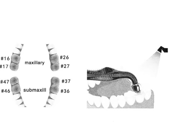 Dental Occlusal Stamp Kit | For Posterior Composite Restorations (16Pcs/Pack)