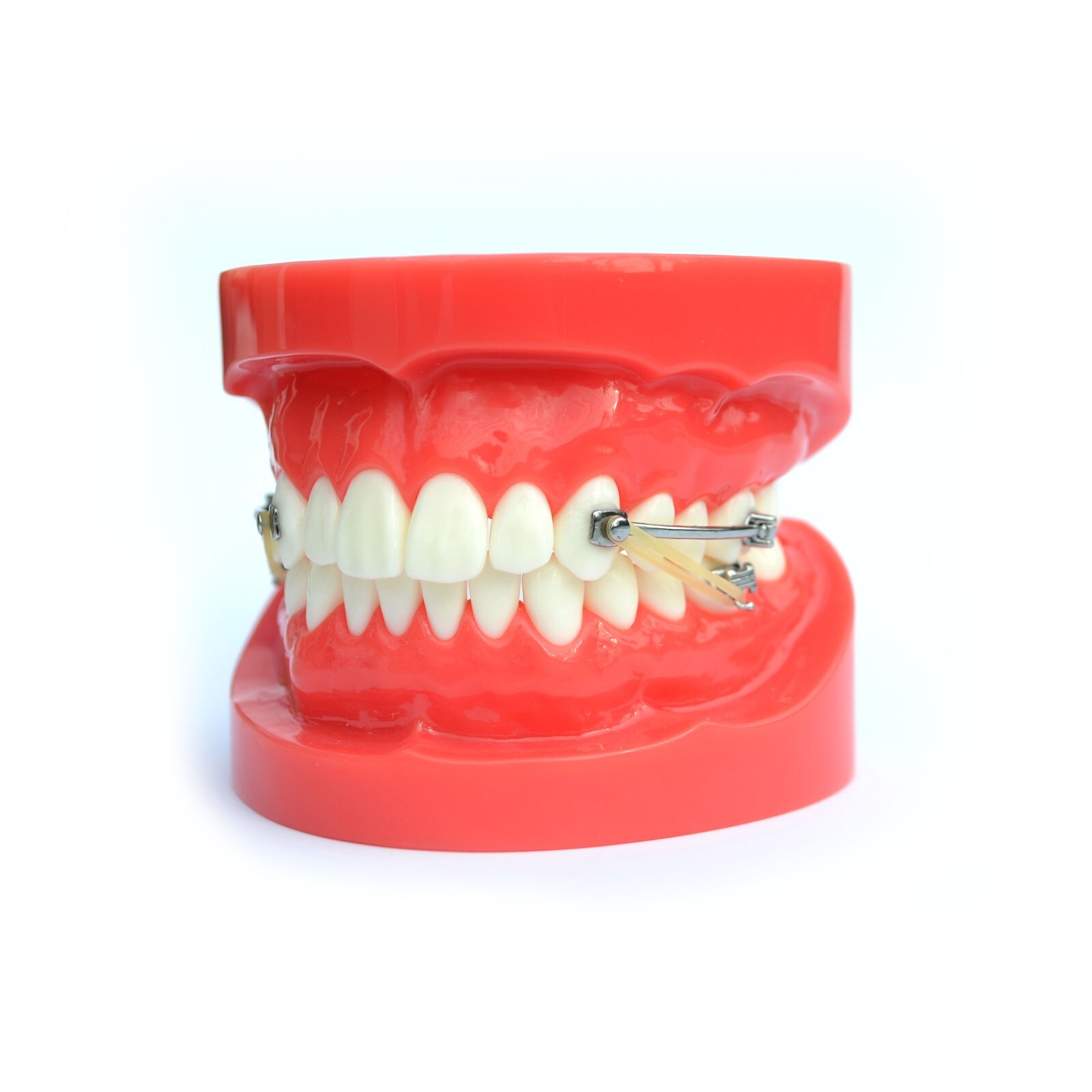 J&J Ortho™ BiteForce™ Orthodontic Bondable Distalizing Bar Appliance (2/pair)