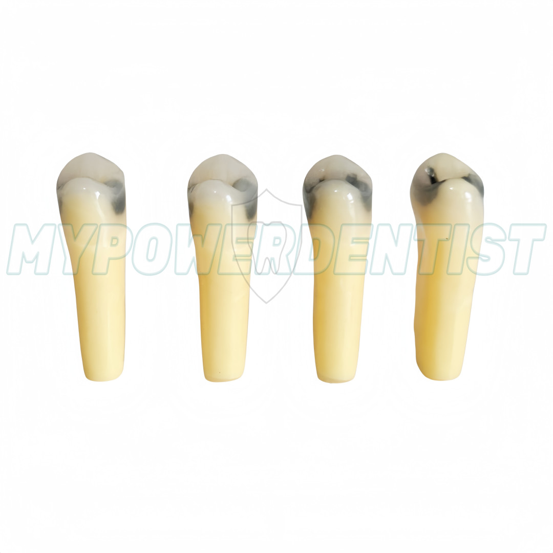 25# Dental Cavity Teeth Model Tooth Teaching Caries ModelCompatible Frasaco AG-3
