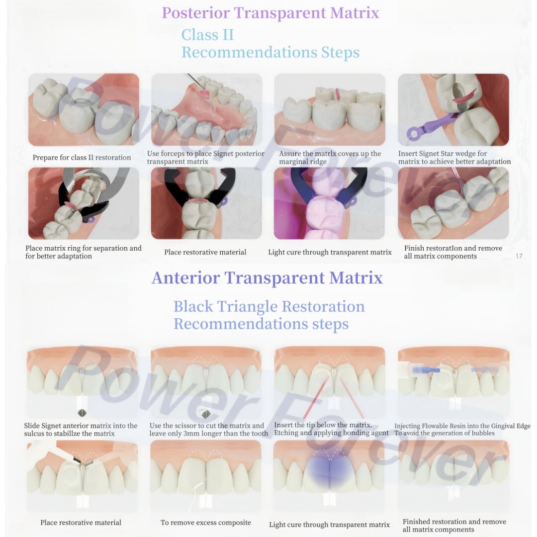 Dental Clear Matrix Diastema BT Matrices Wedges Similar with BioClear Matrice